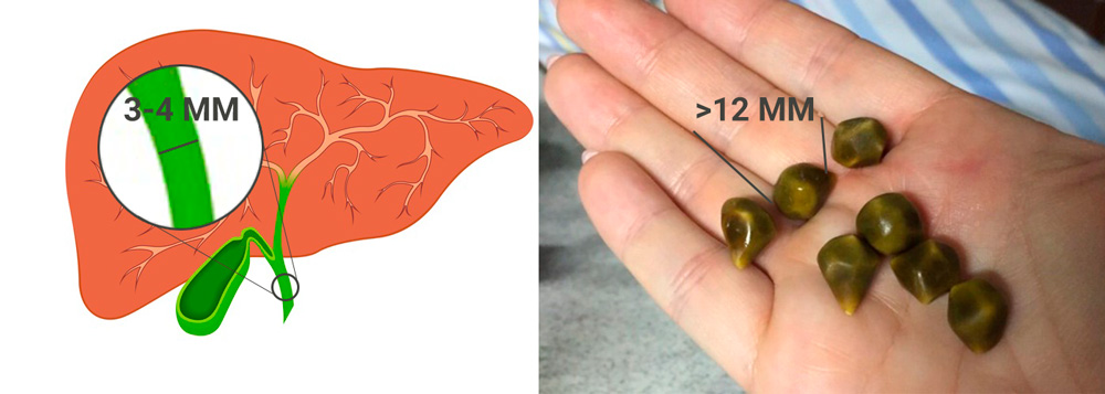 Камни печени