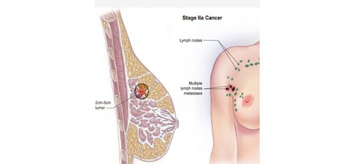 рак груди 2 стадии лечится