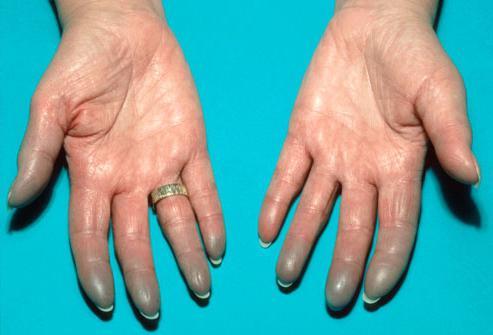 Почему синеют ногти на руках и ногах, что можно сделать с проблемой в домашних условиях?