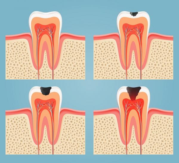 Стадии поражения зуба