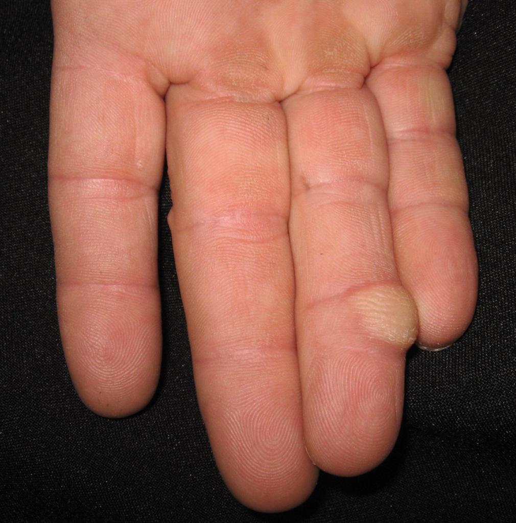 Рак пальца: фото, симптомы и лечение