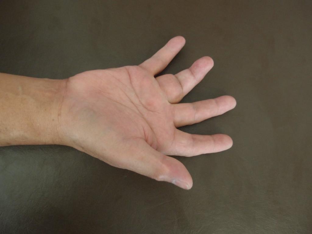 Рак пальца: фото, симптомы и лечение
