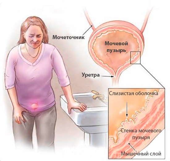 признаки цистита