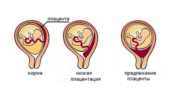 виды предлежания