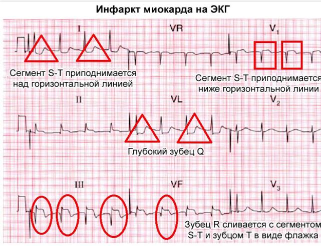 инфаркт миокарда