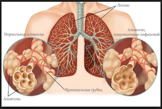 энфизема легких
