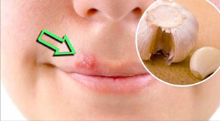 cold sores on the lips treatment with folk remedies quickly