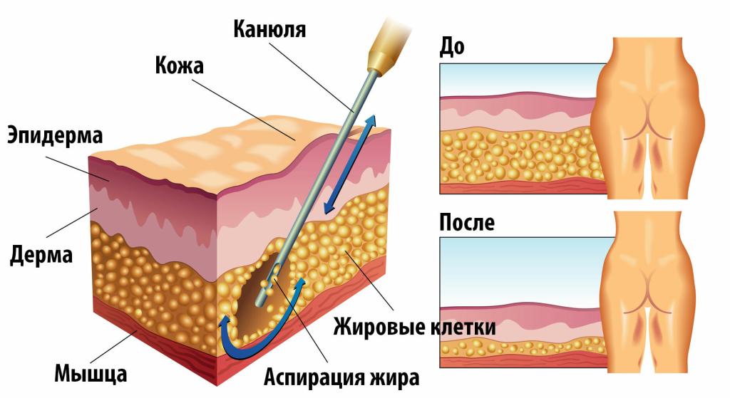 лазерная липосакция отзывы