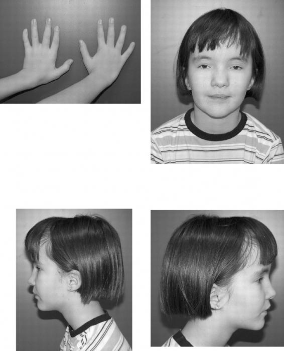 Синдром рассела сильвера фото детей симптомы