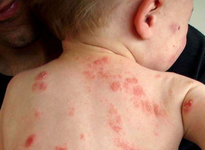 Виды дерматита у детей