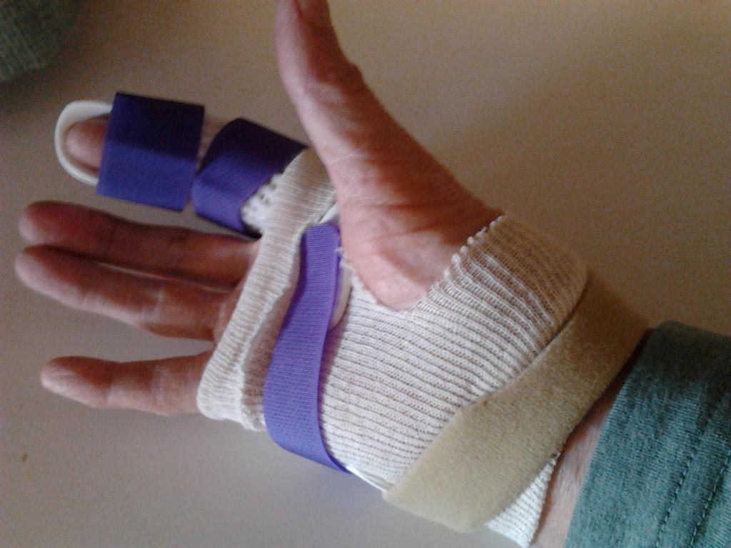 повязка при переломе пальца на руке