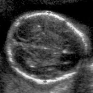 Окружность головы по месяцам таблица беременности thumbnail