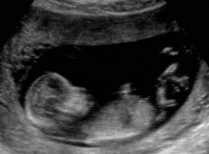 Окружность головы ребенка по неделям беременности норма таблица thumbnail