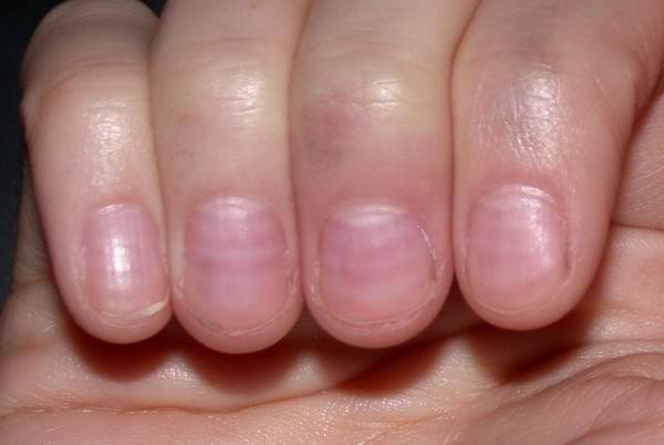 Как лечить белые пятна на ногтях рук 20