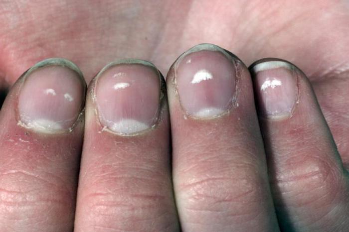 Как лечить белые пятна на ногтях рук 22