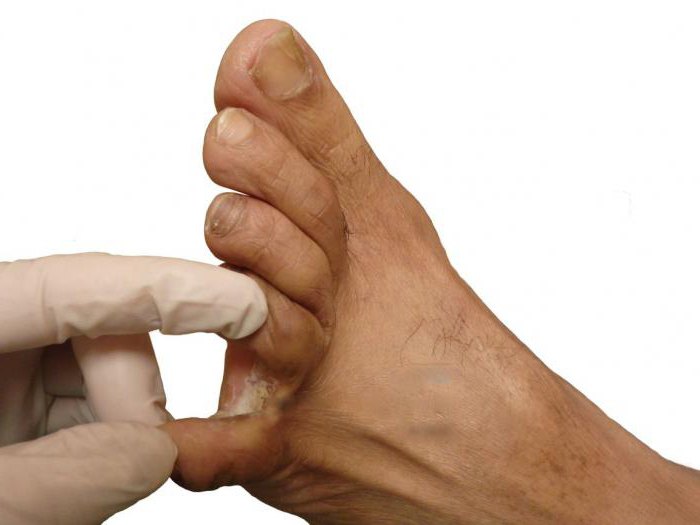 мозоль между пальцами ноги лечение
