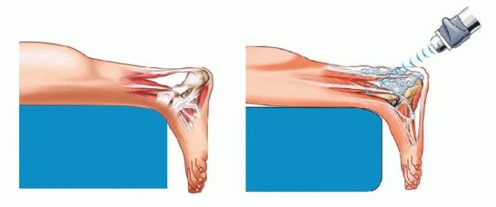 methods for the treatment of heel spurs