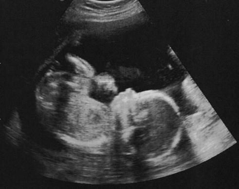 Узи в 20 недель беременности фото мальчика