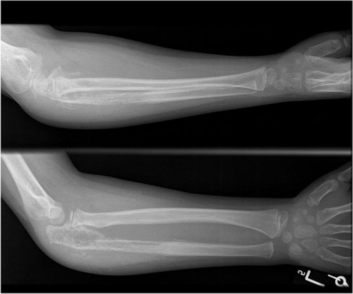 Перелом локтевой кости. Трещина локтевой кости рентген. Локтевая кость рентген перелом. Перелом руки локтевая кость. Лучевая и локтевая кости на рентгене.