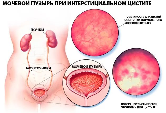 бактериальная инфекция мочевого пузыря