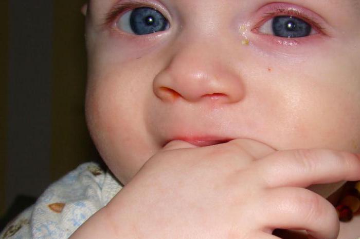 Противовирусные капли для глаз для детей