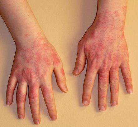 Аллергия на резиновые перчатки чем лечить thumbnail