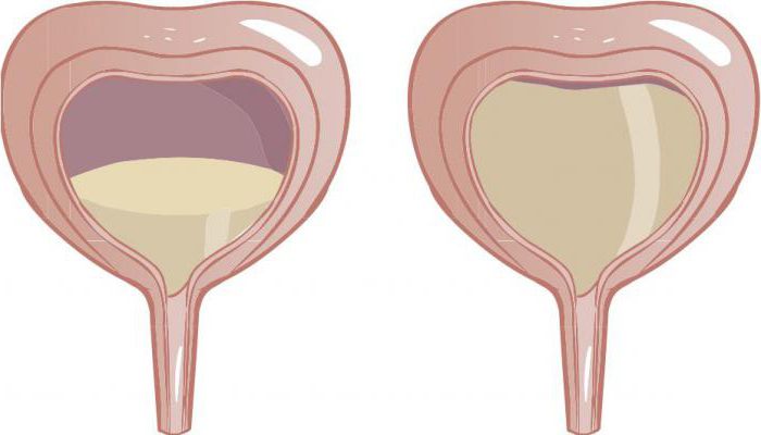 гиперактивный мочевой пузырь у женщин причины лечение