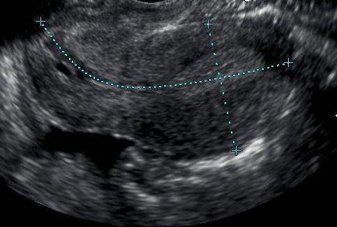 размеры шейки матки по узи норма