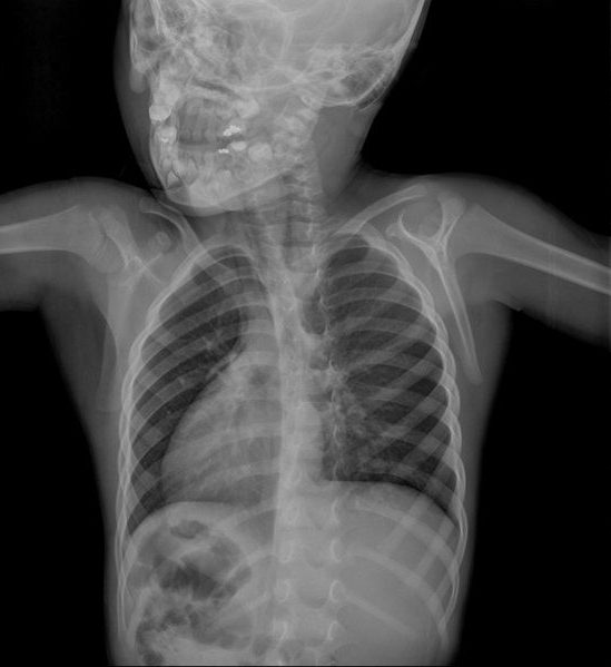 Как часто можно делать рентген детям и его вред