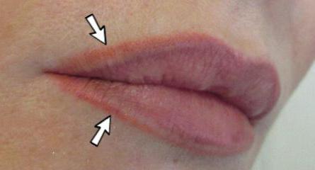 lip correction after tattoo