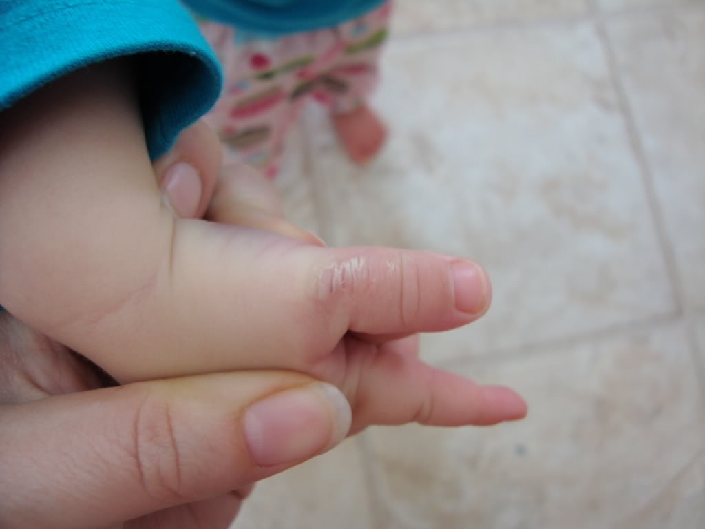 Негативные последствия от сосания пальцев