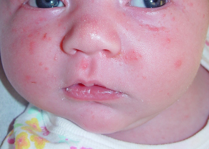 Features of pyoderma in children