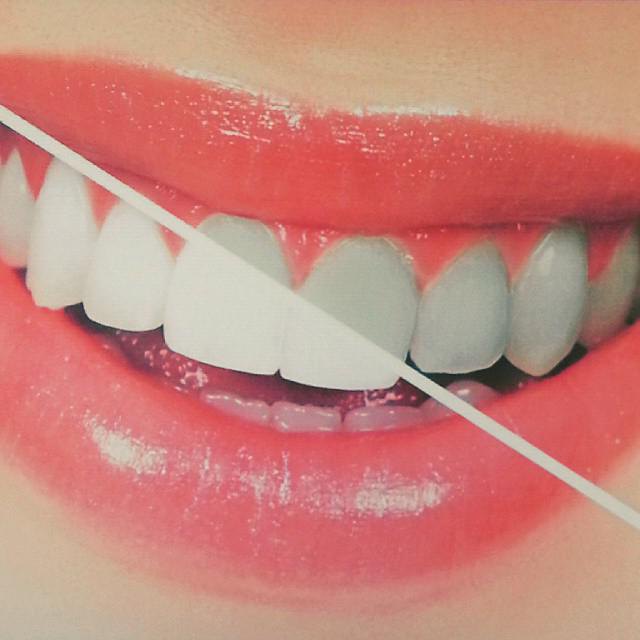 3d white crest whitestrips. Отзывы 