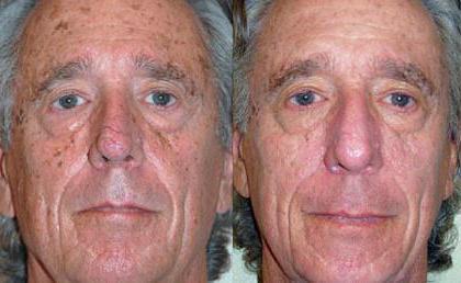 facial rejuvenation after 60 years without surgery