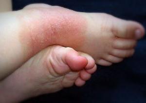  атипичный дерматит у детей