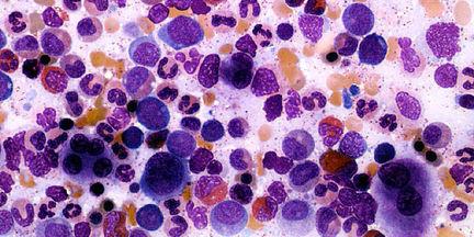 понижены лимфоциты в крови