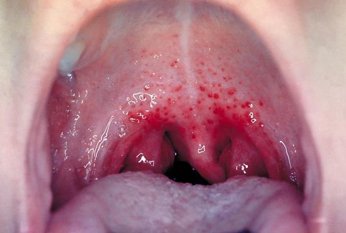 herpes sore throat in children treatment