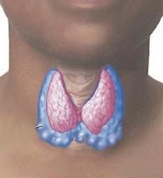 узлы на щитовидке лечение