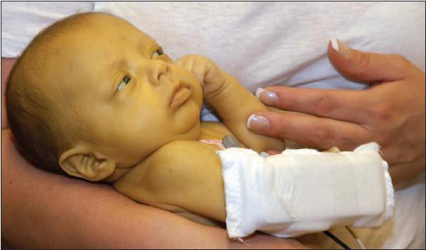 Желтушка у новорожденных при гепатите thumbnail