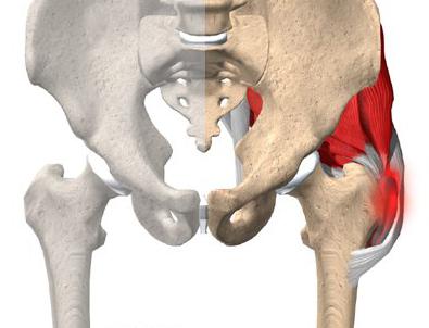 hip trochanteritis symptoms