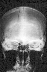 перелом основания черепа