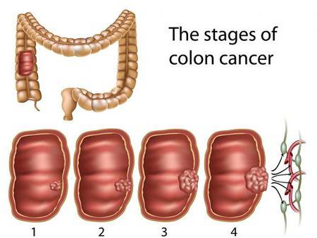 как провериться на рак кишечника