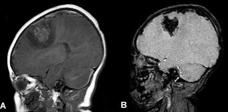 brain injuries traumatic brain injury in children