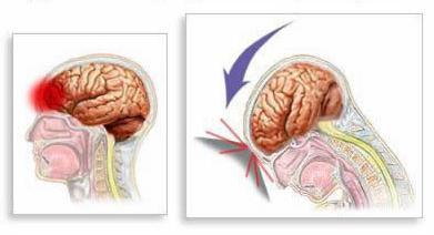 diffuse axonal damage