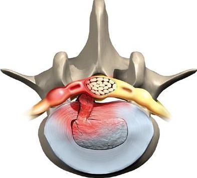 протрузии пояснично крестцового отдела позвоночника