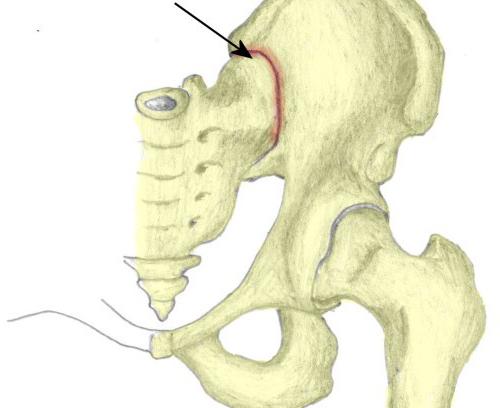 крестцово подвздошное сочленение