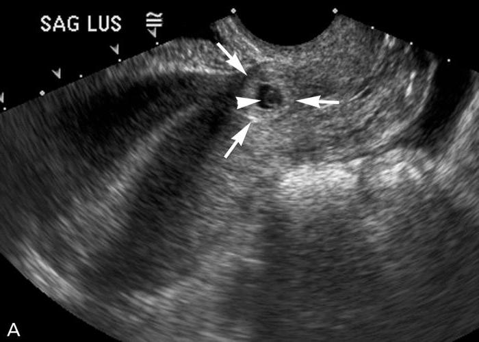 Внематочная эндометрий. Внематочная Трубная беременность УЗИ. УЗИ при трубной внематочной беременности. Разрыв маточной трубы на УЗИ. Шеечная беременность УЗИ.