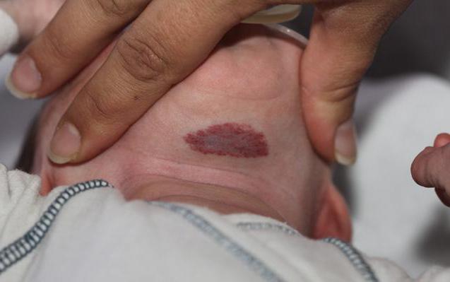 красный затылок у новорожденного