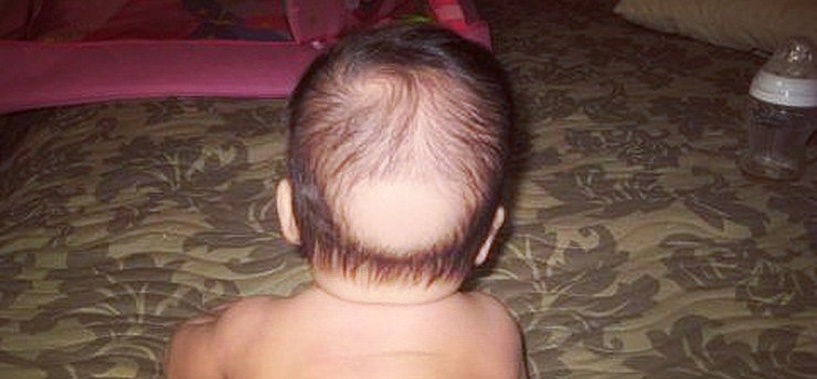 Почему у новорожденного много волос на голове