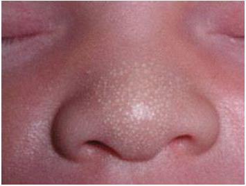белые точки на носу у новорожденного